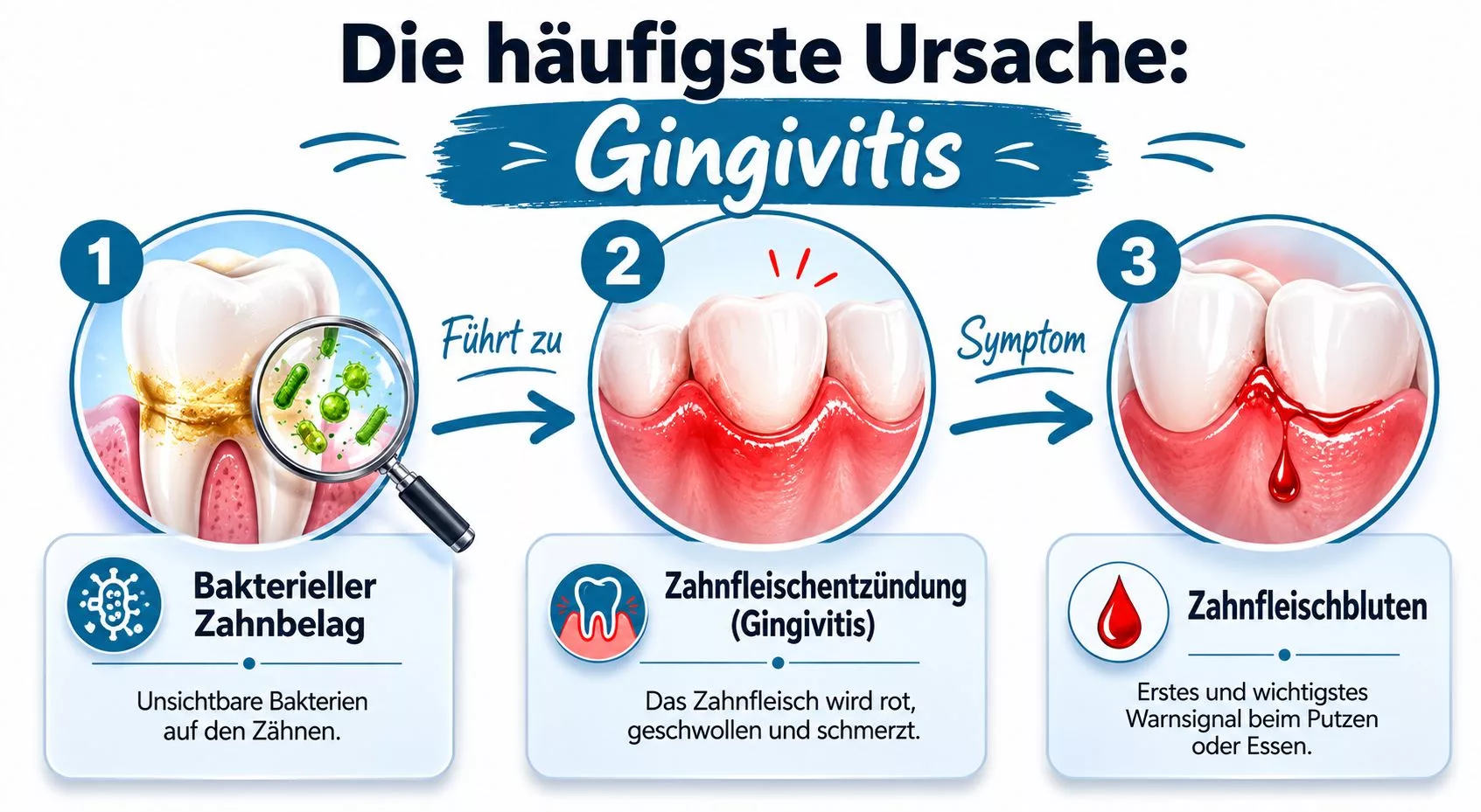 Infografik zur Entstehung von Zahnfleischentzündungen und Zahnfleischbluten durch bakteriellen Zahnbelag in drei verständlichen Schritten erklärt.