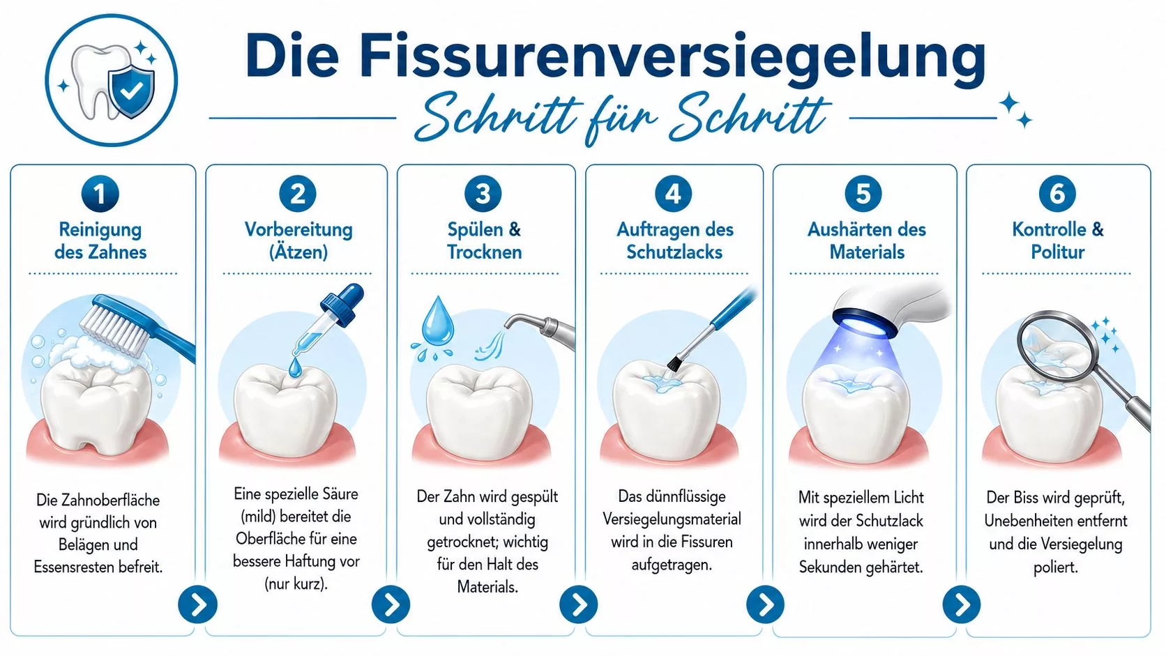 Eine Infografik erklärt die sechs Schritte einer Zahnfissurenversiegelung, von der Reinigung bis zur finalen Kontrolle und Politur.