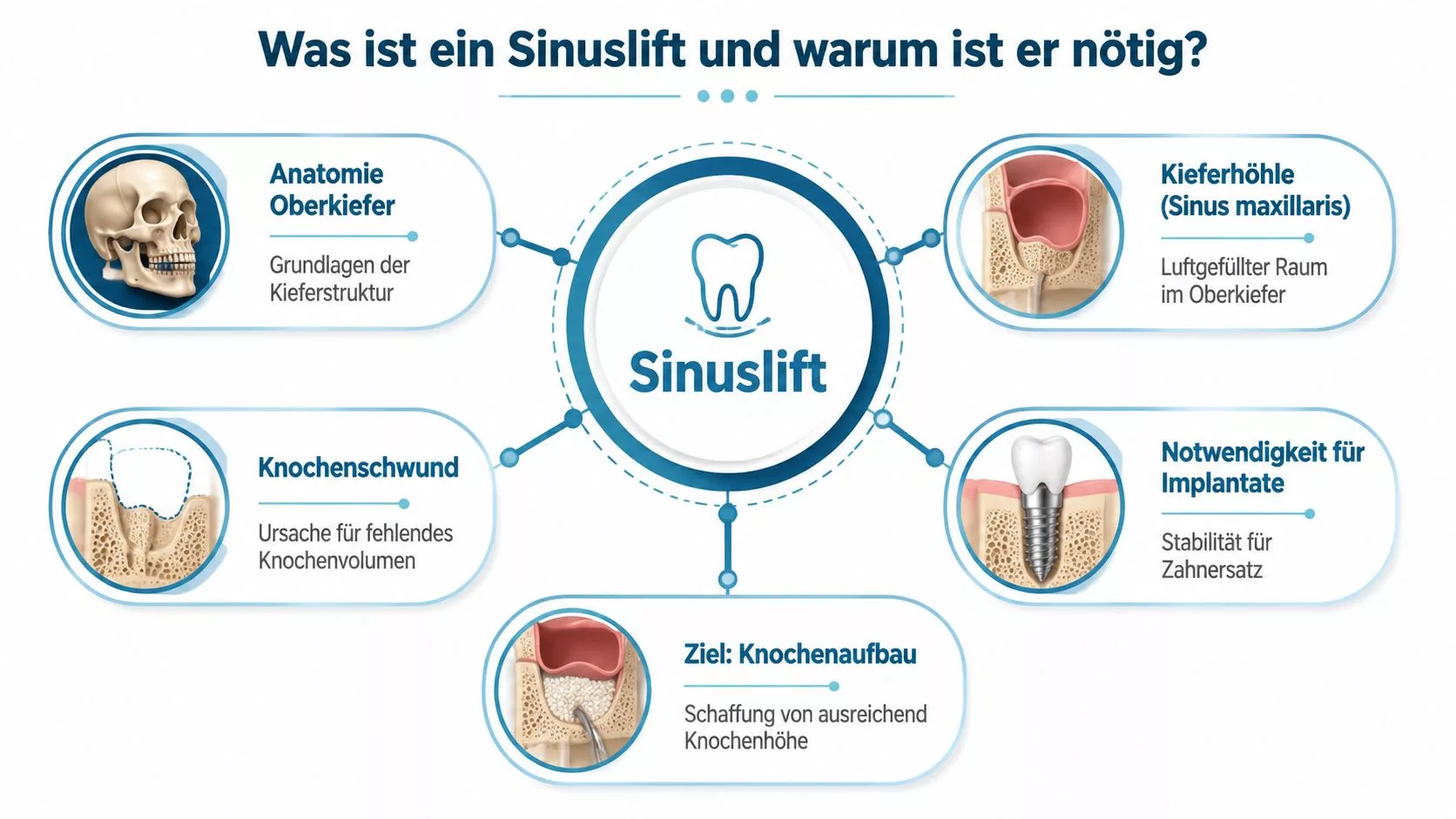 Infografik zum Sinuslift-Verfahren, das Knochenaufbau zur Vorbereitung für Zahnimplantate im Oberkiefer erklärt und veranschaulicht.