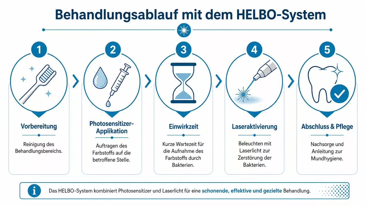 Infografik zum fünfstufigen Behandlungsablauf der professionellen HELBO-Lasertherapie für effektive Mundhygiene und Bakterienbekämpfung.