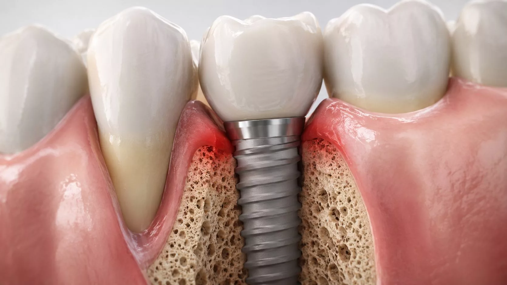 Eine grafische Darstellung von Periimplantitis mit Entzündungen am Zahnfleisch und Knochenschwund um ein Zahnimplantat herum.