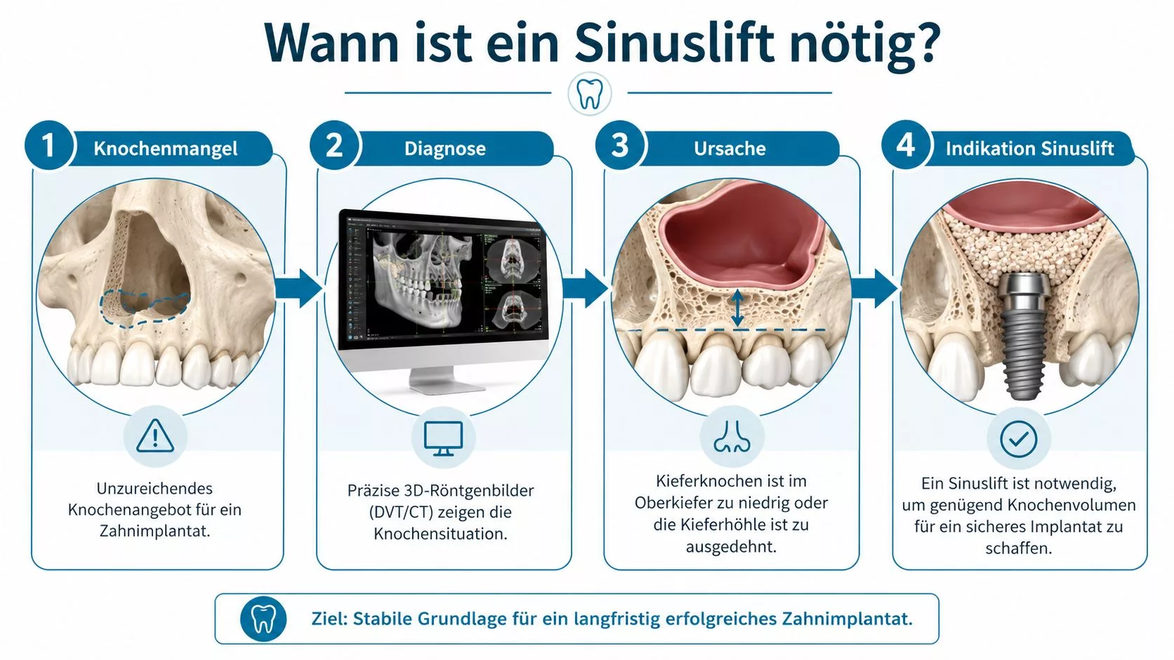 Infografik zeigt die vier Schritte vom Knochenmangel bis zur notwendigen Sinuslift-Behandlung für ein sicheres Zahnimplantat im Oberkiefer.
