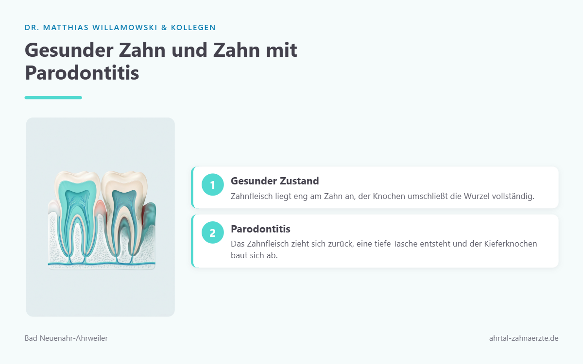 Vergleichende Querschnittzeichnung: links ein Zahn mit gesundem Zahnfleisch und Knochen, rechts ein Zahn mit entzündetem, zurückgezogenem Zahnfleisch, vertiefter Tasche und Knochenabbau