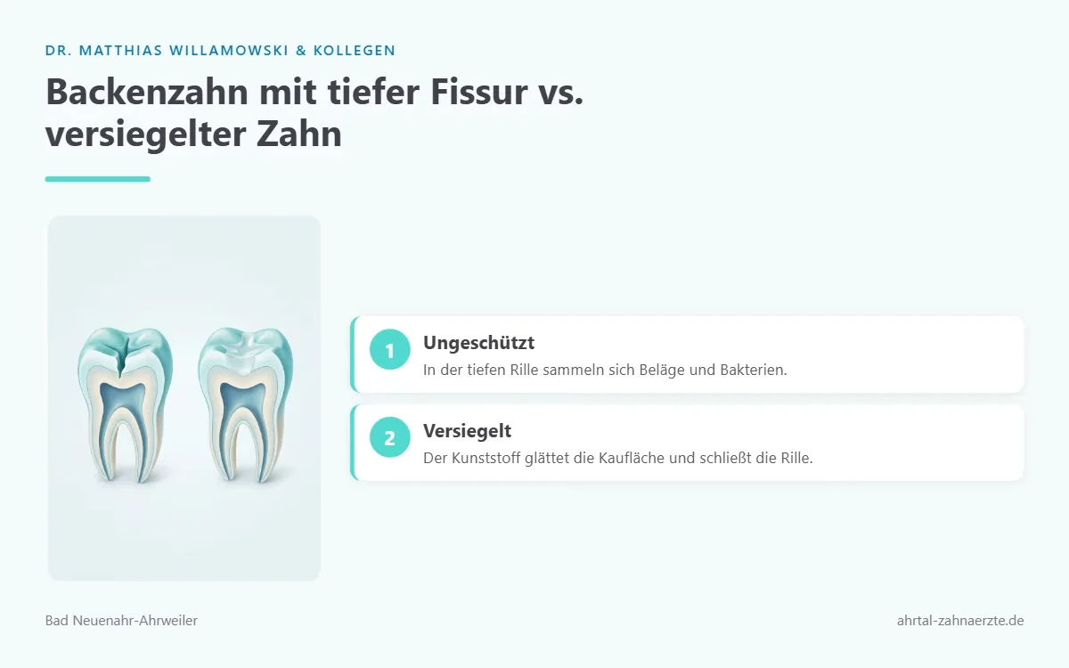 Zwei Querschnitte eines Backenzahns nebeneinander links eine tiefe enge Fissur in der Kaufläche rechts dieselbe Fissur mit hellem Versiegelungsmaterial glatt aufgefüllt