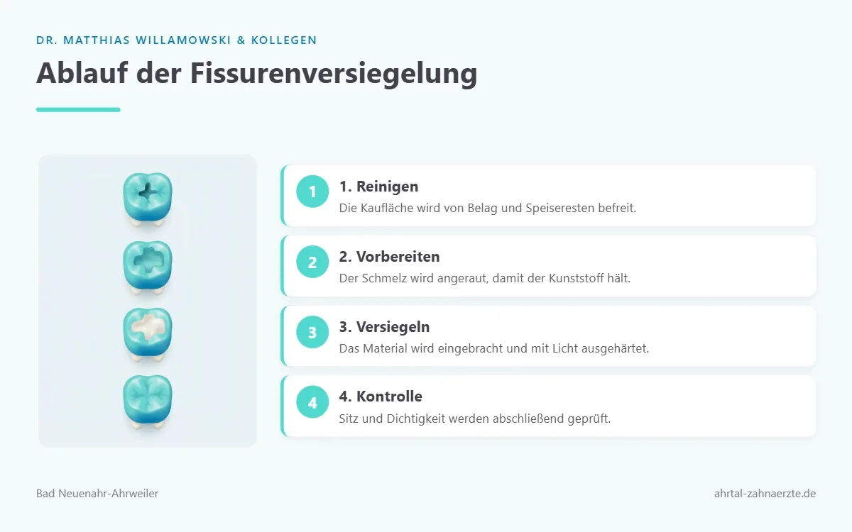 Vier stilisierte Backenzähne in einer Reihe, die nacheinander die Schritte Reinigen, Anrauen, Auftragen des Versiegelungsmaterials und fertige glatte Kaufläche zeigen.