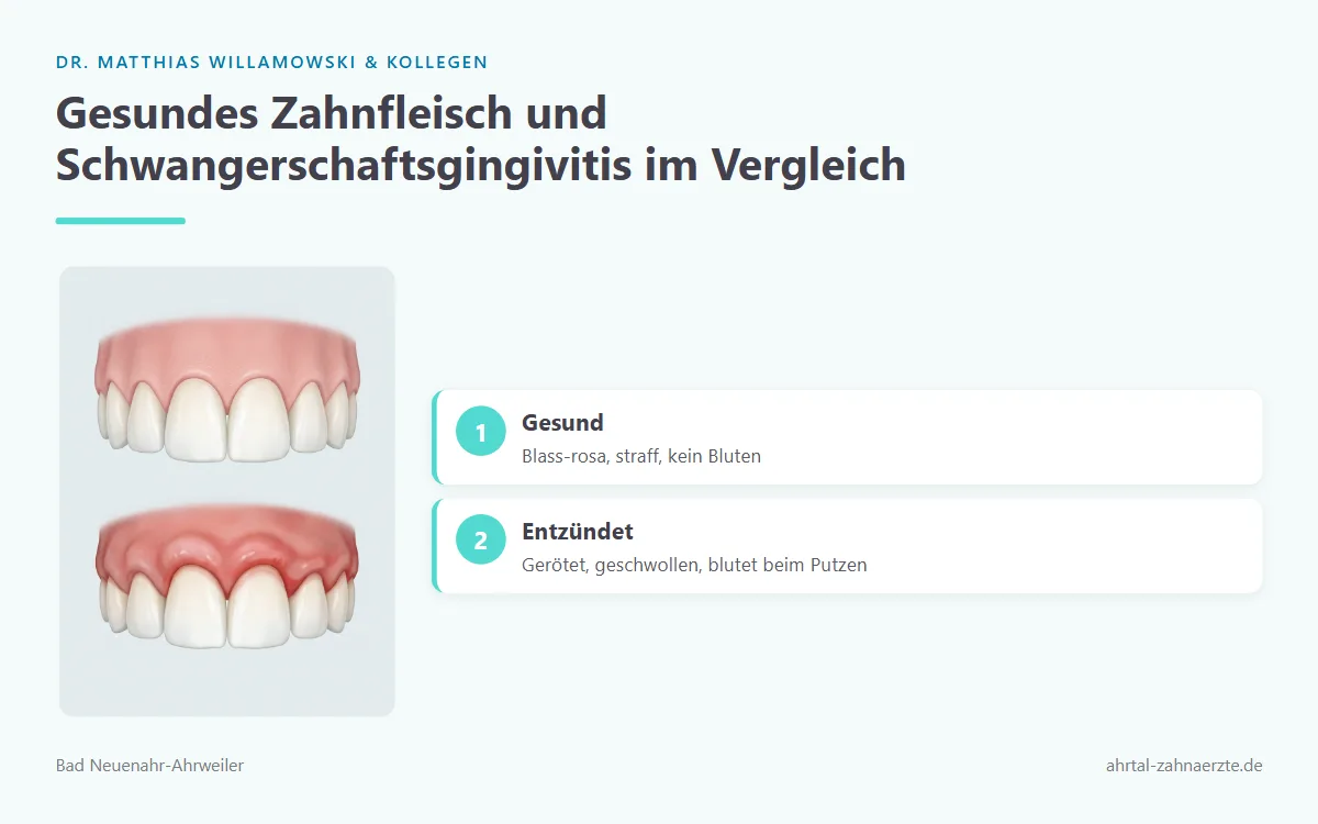 Zwei nebeneinander dargestellte Zahnfleischpartien an der Zahnbasis: links straffes, blass-rosafarbenes gesundes Zahnfleisch, rechts gerötetes, geschwollenes und leicht blutendes Zahnfleisch